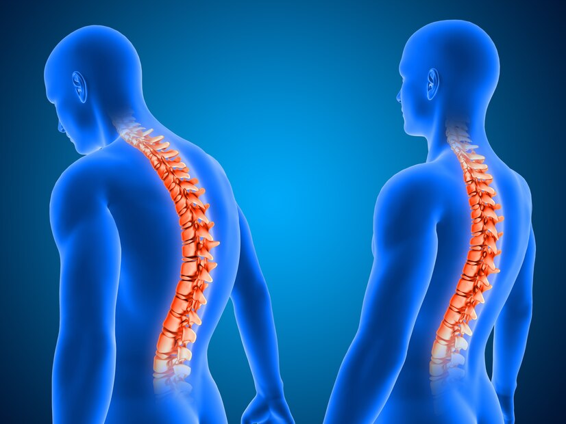 Spinal Surgery and Deformity Correction
